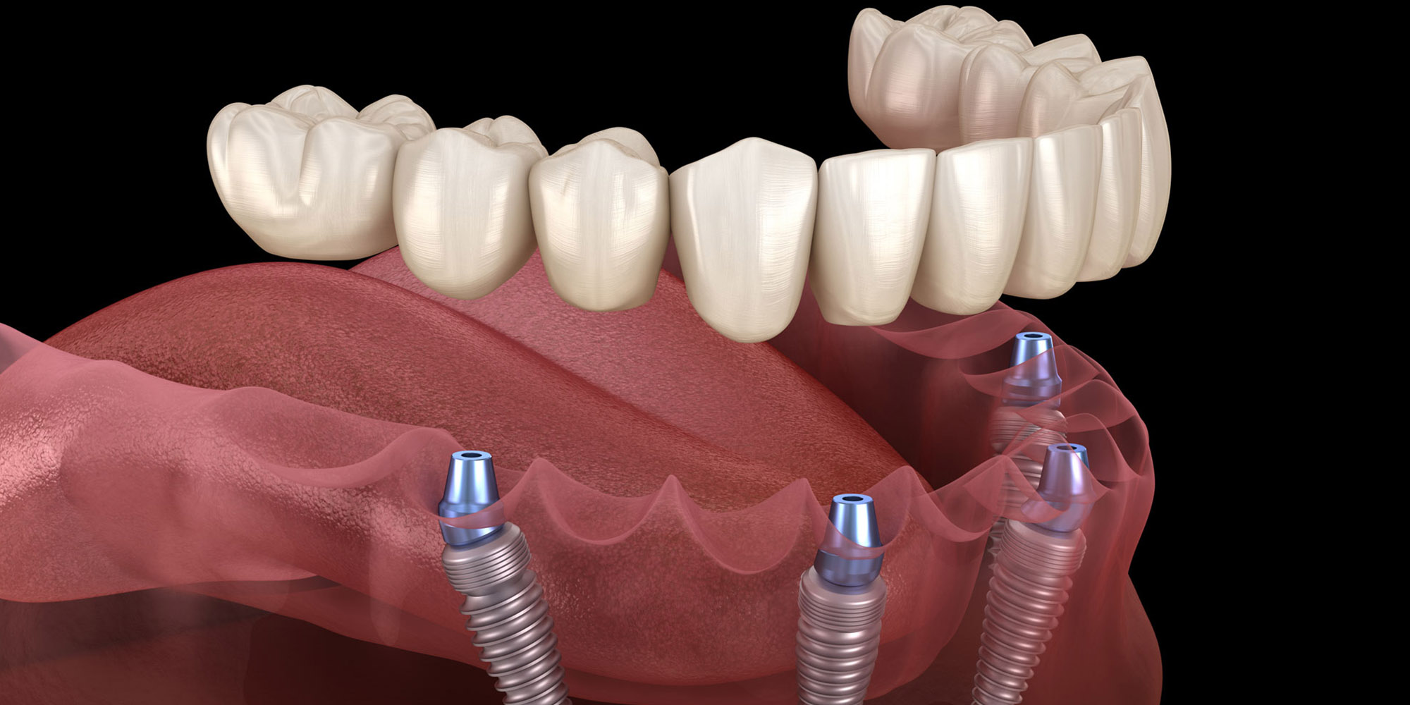 Fixed Teeth Solutions by Dental Implants
